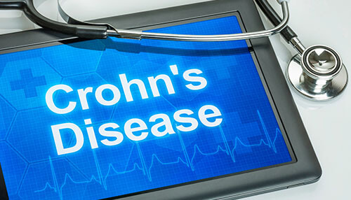 Crohn's disease What is the action of stem cells in treating crohn's disease biologics therapy Crohn’s Disease