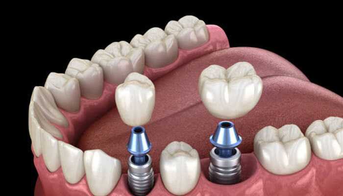 Dental implant solutions Advantages of choosing dental implants dental implant solutions