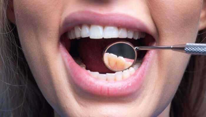 Root canal Darkening or discoloration of the tooth and root canal necessity