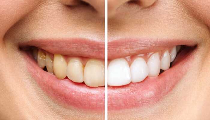 Marketing tips for dental practices to promote teeth whitening products - tycoonstory | tycoonstory media Before and after comparison of a smile showing the results of using effective teeth whitening products.