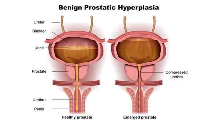 Risk factors for benign prostatic hyperplasia | tycoonstory media Risk factors for benign prostatic hyperplasia