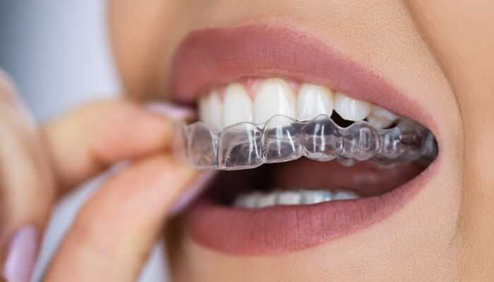 Clear aligners - tycoonstory | tycoonstory media Close-up of a woman using clear aligners to fix misaligned teeth and achieve a confident smile.