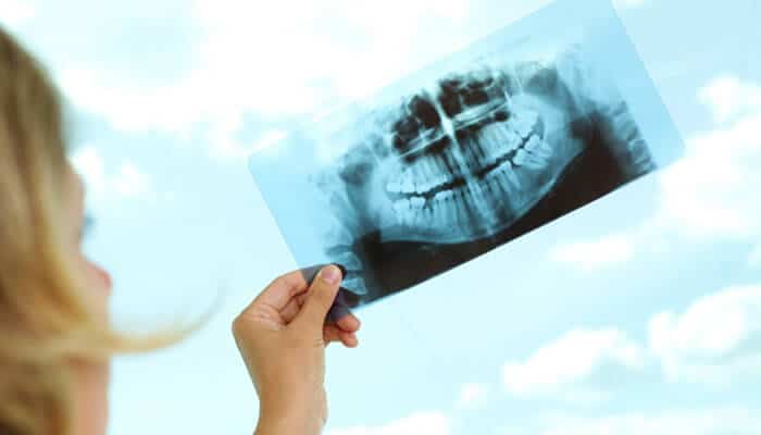 Dental implants and snoring guards A dentist holding up a dental x-ray image against the sky, examining the patient’s teeth structure to plan treatments like dental implants and snoring guards for improved oral health.