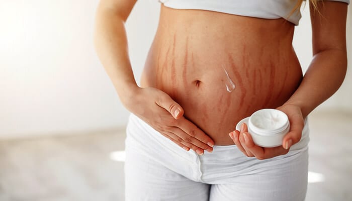 Woman applying ointment for stretch marks postpartum on her abdomen to reduce visible lines and support skin healing after pregnancy.