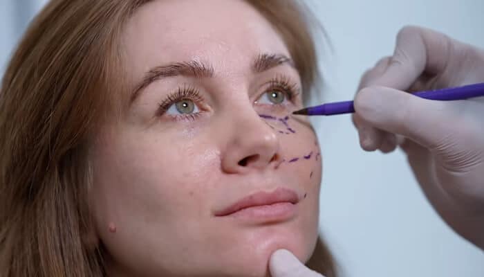 Improving under-eye hollows | tycoonstory media A woman undergoing a fat grafting procedure with markings on her face. A doctor is preparing to enhance the under-eye area using fat transfer for a smoother look.