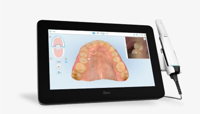 Top intraoral scanner for invisalign - itero lumina | tycoonstory media Top intraoral scanner for invisalign - itero lumina