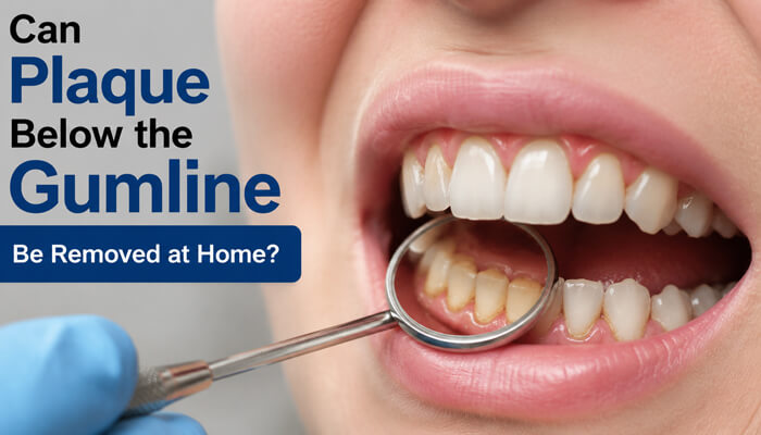 Can plaque below the gumline be removed at home - tycoonstory | tycoonstory media How to remove plaque from teeth below the gumline during a professional dental examination