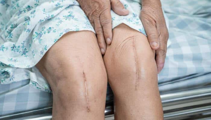 12 disadvantages of knee replacement surgery 1 | tycoonstory media Disadvantages of knee replacement surgery showing healed surgical scars on both knees during the recovery process after total knee replacement