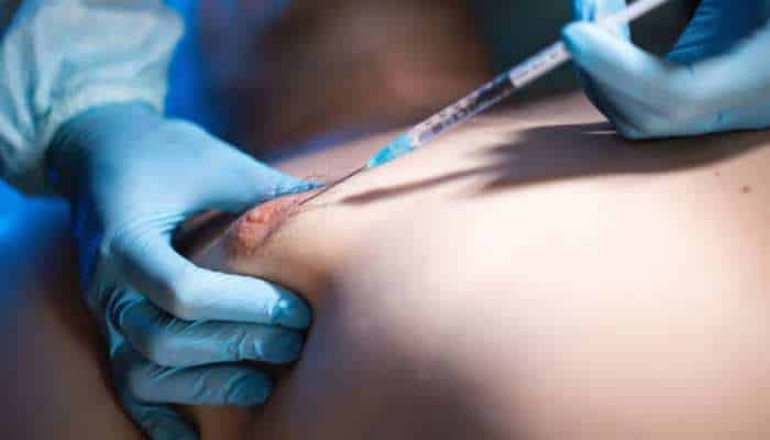 Gynecomastia in dubai 1 | tycoonstory media Medical professional in blue gloves administers a syringe injection into a patient’s shoulder/upper back area.