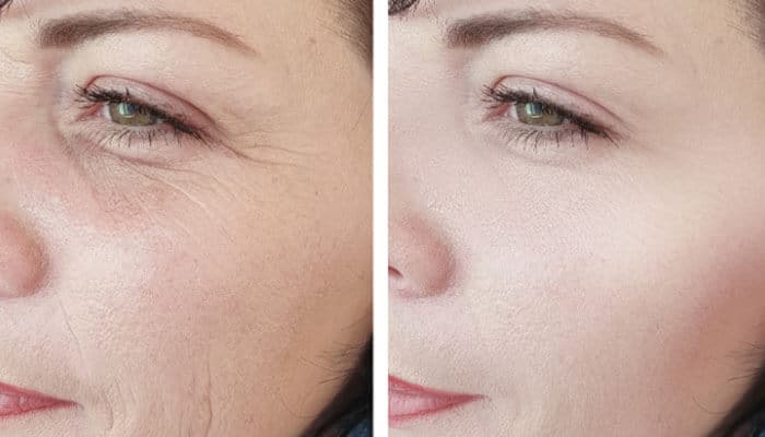 Why is blepharoplasty swelling worse in the morning - tycoonstory | tycoonstory media Upper blepharoplasty recovery photos day by day showing a close-up before-and-after comparison of eyelid swelling, skin contour, and healing after surgery.