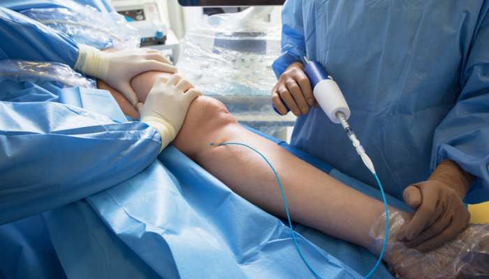 When minimally invasive vein care becomes the much better choice 1 | tycoonstory media Surgeons in blue gowns operate on a patient's leg, using a handheld arthroscopic instrument in a sterile setup.